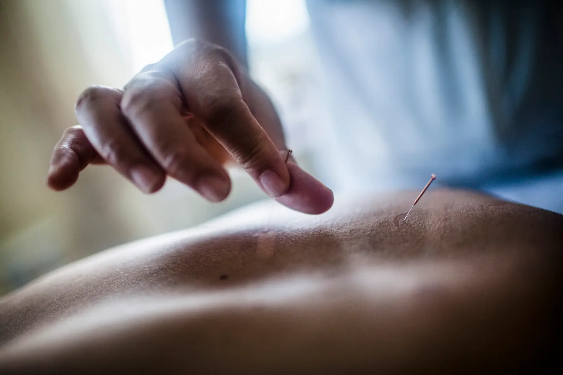 Dry needling